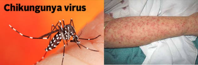 El virus chikungunya es creciente en EEUU